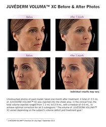 Bednar Cosmetic Surgery of Charlotte First in the Area to Offer VOLUMA